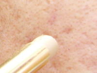 ニキビ跡の隠し方